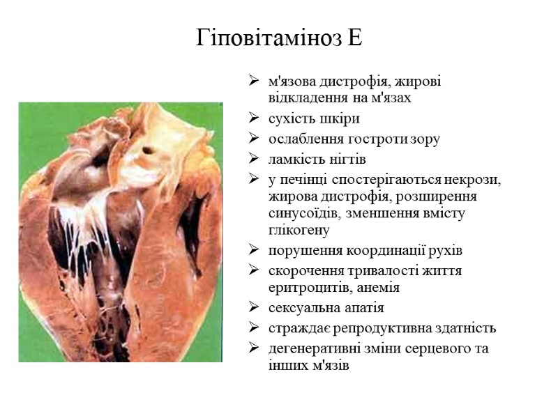 Гіповітаміноз Е м'язова дистрофія, жирові відкладення на м'язах сухість шкіри ослаблення гостроти зору ламкість
